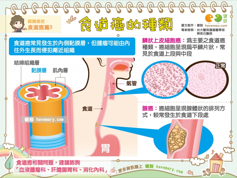 食道癌,食道,癌症,惡性腫瘤,健康圖文,健康漫畫,漫漫健康,圖解健康,Esophageal cancer, esophagus, cancer,malignant tumor,健談,健談網,havemary